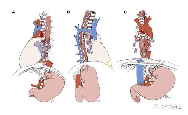 胃淋巴结分区图图片