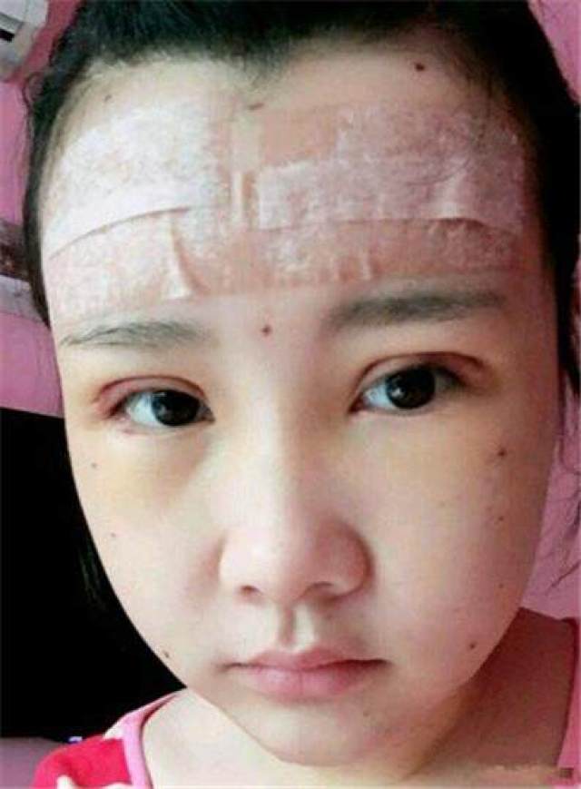 做自体脂肪填充 双眼皮后,我自拍一下,看到自己真的丑的想哭