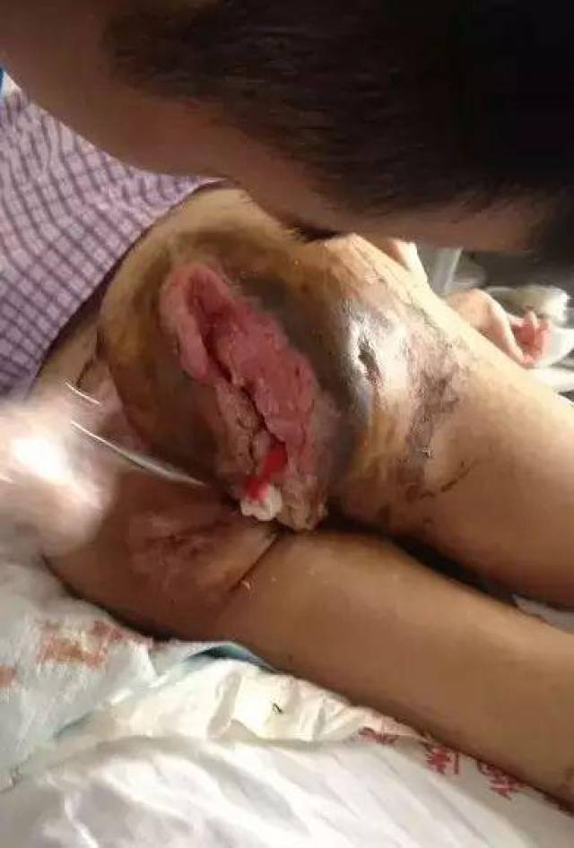 一般来说,老年病人与长卧不起的人更易患褥疮,因为老年人新陈代谢差