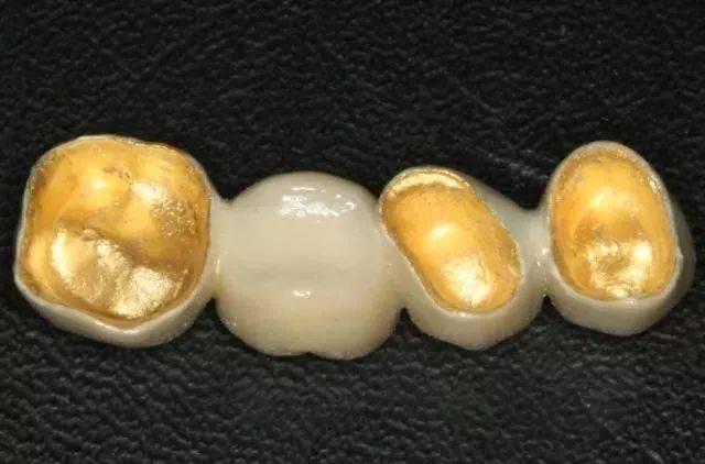 牙医说,有种牙冠不能选