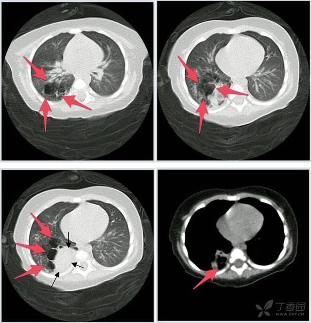 辅助检查: 胸片提示:支气管炎表现;不排除右下肺先天性含气囊肿; 左