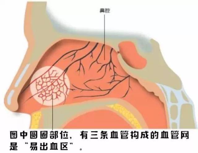 幼儿园意外伤害之鼻出血