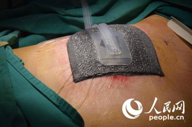 创伤治疗有了新方法 你知道什么是vsd吗?