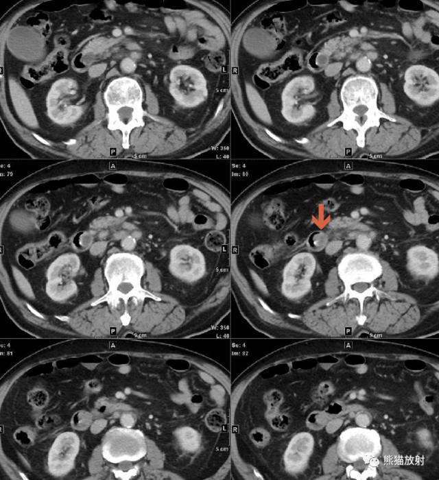 病例专题丨十二指肠良性及恶性肿瘤的影像表现