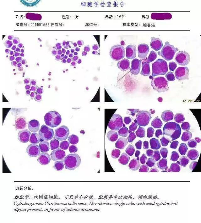 胸腹水细胞图文报告