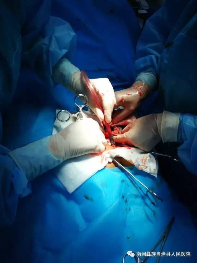 因包块巨大,给行囊液抽吸减少张力后,施行了巨大包块切除术,手术经过