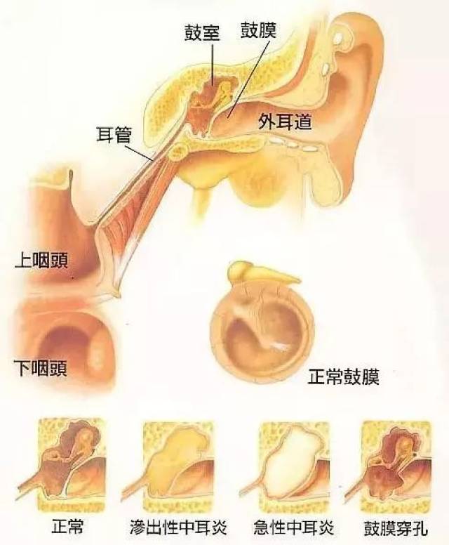 区分油耳和中耳炎图片图片