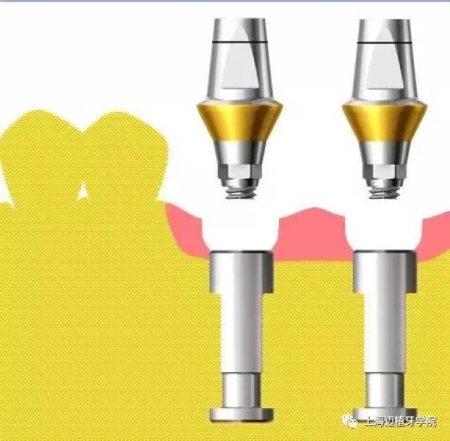 oral cavity andconnect it with analog firmly 連接轉移帽和替代體