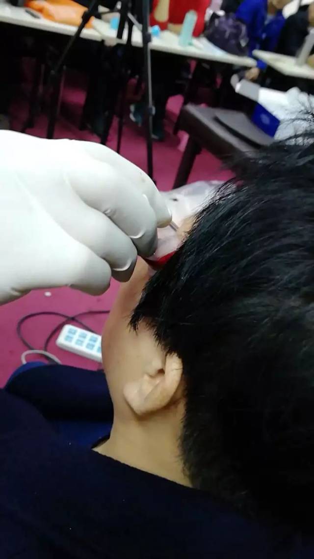 中医放血疗法:刺络放血,舌下取栓(12月20日北京,1月20日杭州)
