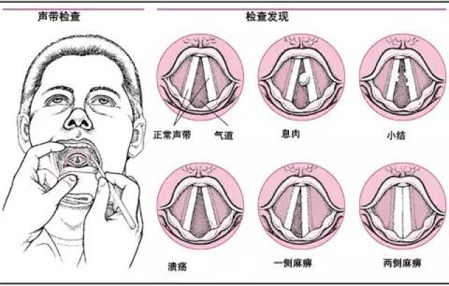 声带裂了图片