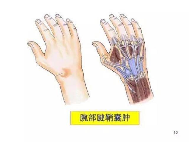 手腕长了不痛不痒的肿块怎么办?