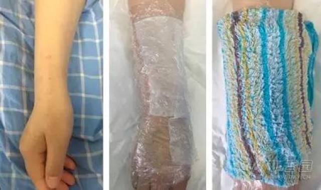 日间硫酸镁温热敷