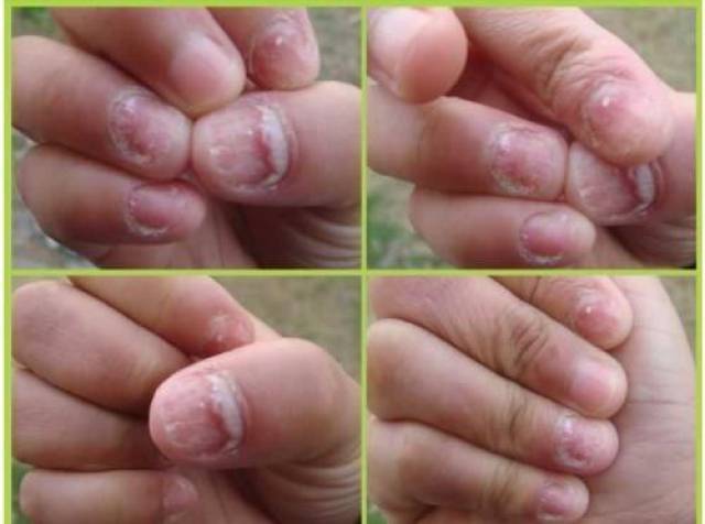 患灰指甲的儿童越来越多,小孩子为什么会得灰指甲?