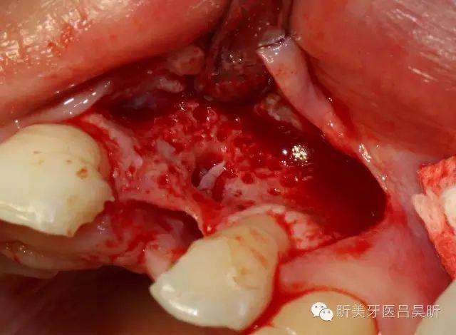 牙槽骨骨刺照片图片