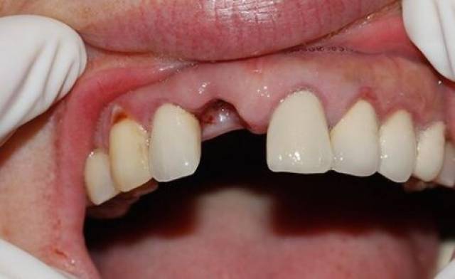 针对牙根尖周炎引起的牙齿松动,可到医院做好患牙的治疗,根尖周炎症