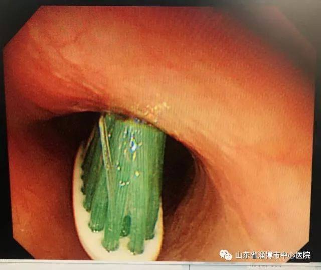 【内镜技术】胃内异物内镜下取出术_手机搜狐网