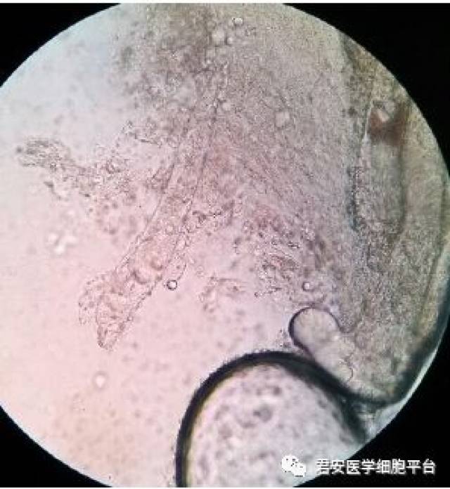 毁容元凶之毛囊虫