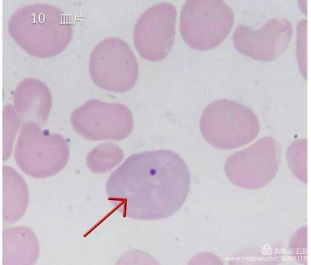 10.含有howell-jolly 小体的嗜多色性大红细胞