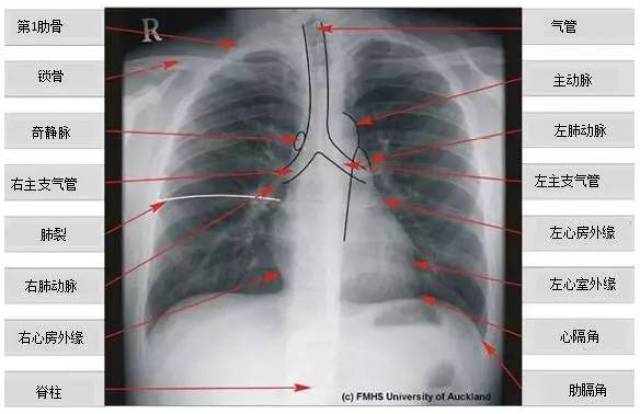 教你看肺部ct片子图片
