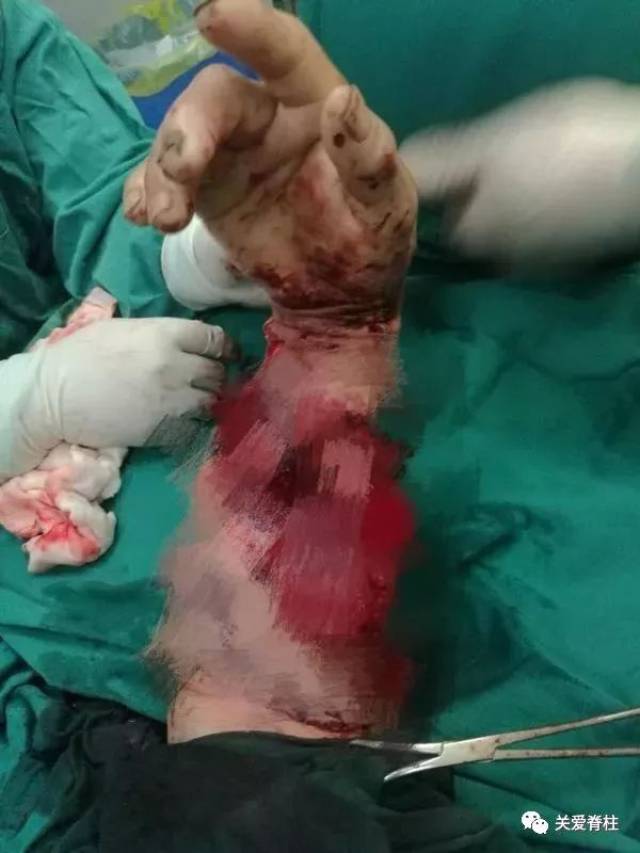 差点成"杨过",骨科深夜抢救一名急危重断肢患者
