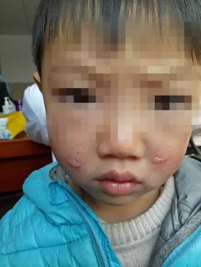 孩子脸上长疱疹的图片图片