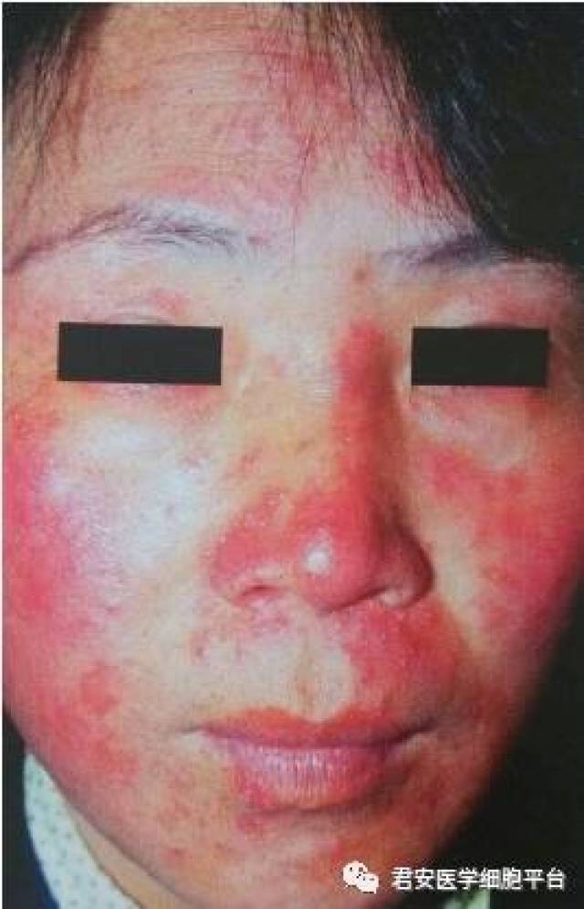 毁容元凶之毛囊虫