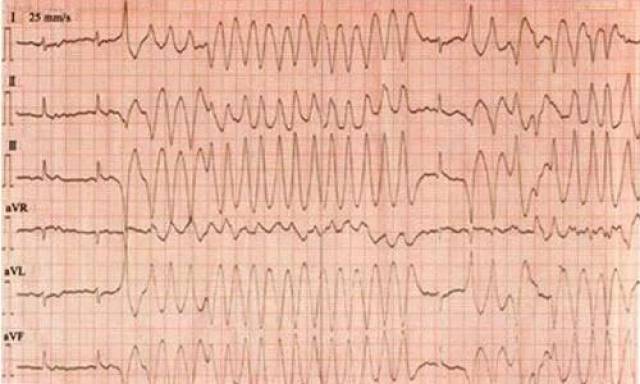 室颤心电图的特点图片