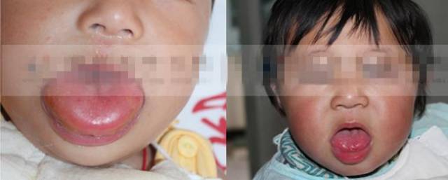 舌头上长血管瘤有哪些症状