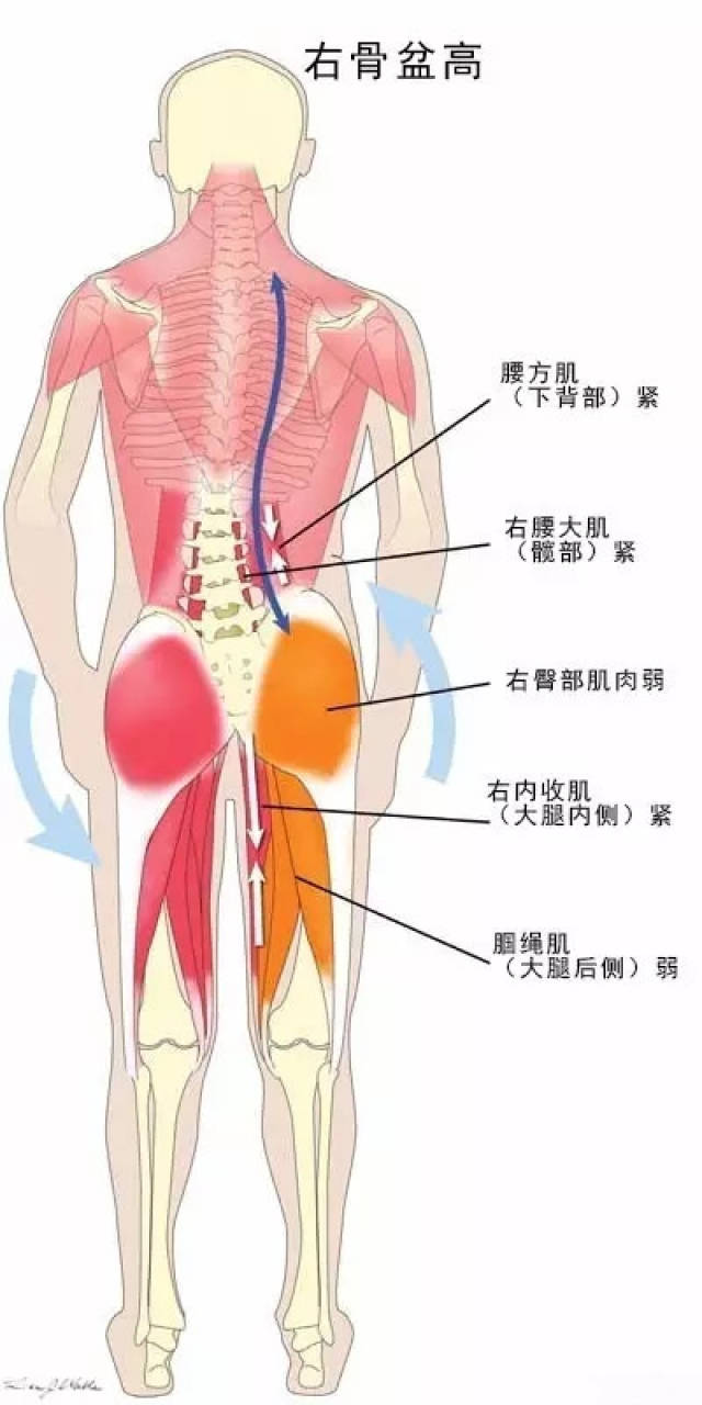 腰痛有4大原因,你是哪一个?