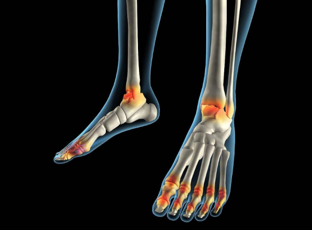 肌腱炎是现代社会引发的一种常见的疾病,由于腱鞘积劳损伤而发生纤维