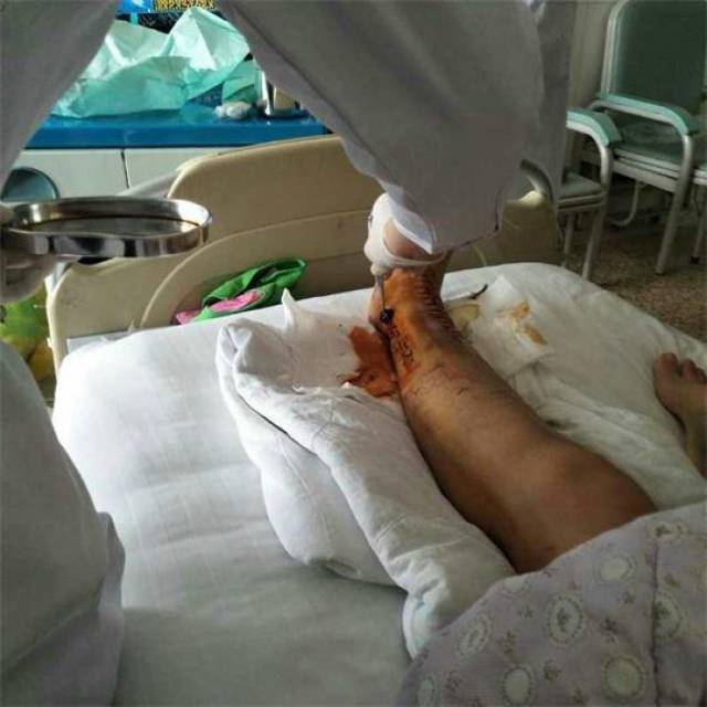 (刚动完手术固定着钢板)