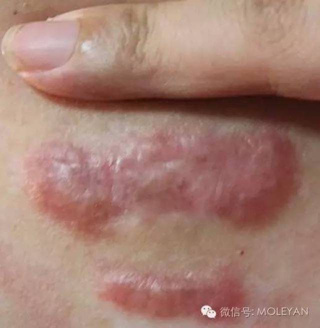 疤痕体质,是指身体的任何部位损伤后,其表现为伤口愈合后,表面疤痕呈