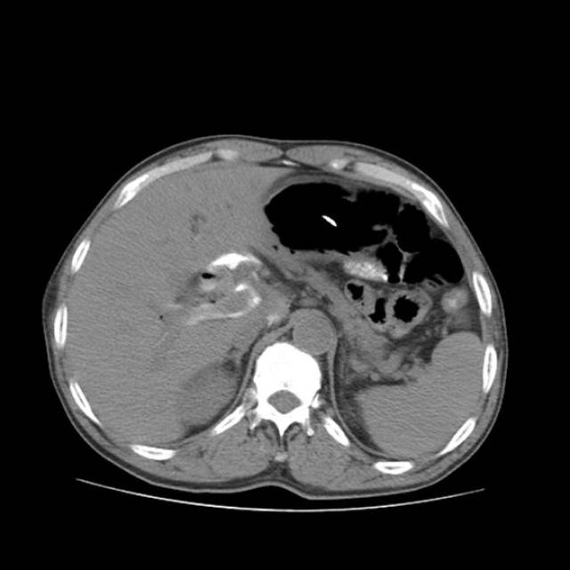 ercp穿孔进入glissons鞘1例
