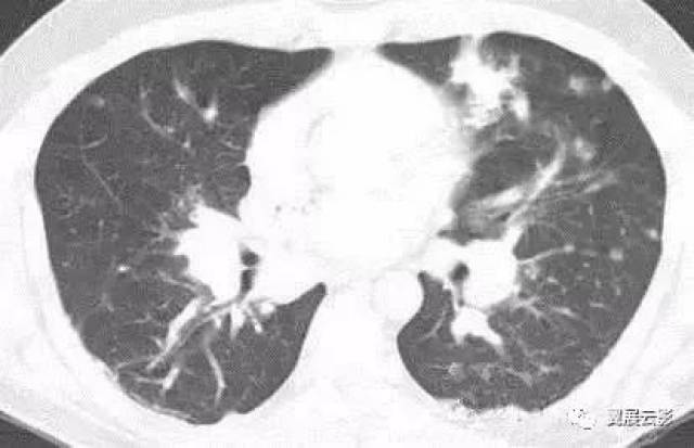 肺转移瘤的13个不典型表现
