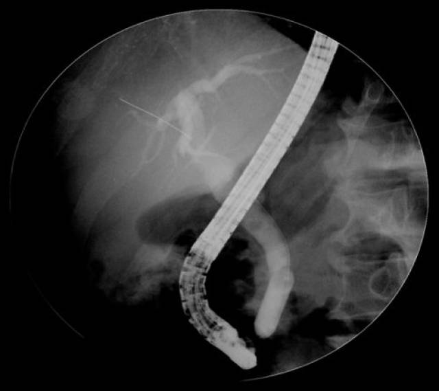 ercp穿孔进入glissons鞘1例