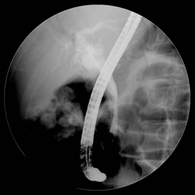 ercp穿孔进入glissons鞘1例-健康频道-手机搜狐