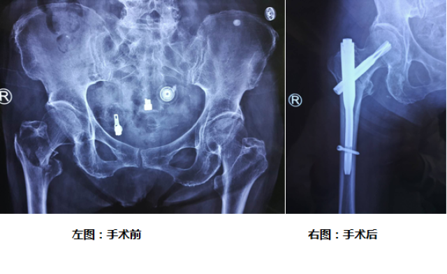 79岁老太摔倒致右侧髋骨骨折微创接骨一个月后扔掉拐杖独立行走