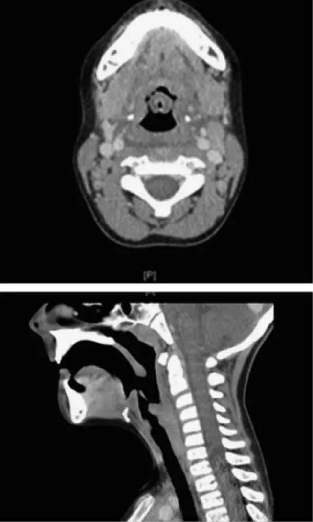 正常喉部CT解剖图片