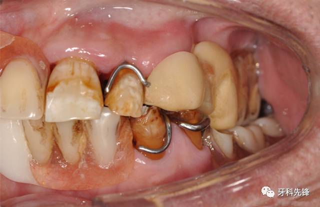 修复上下缺失牙,期间曾断断续续不断有牙齿松动脱落,在原活动义齿上加