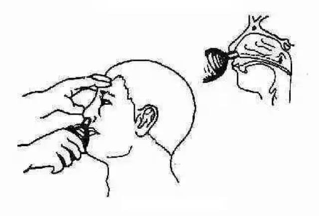 咽鼓管功能的各种检查方法