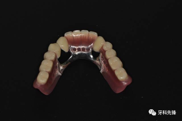 【病例】全口双套冠修复