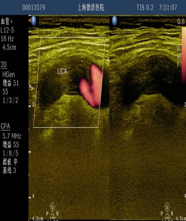 颈动脉体瘤超声表现图片