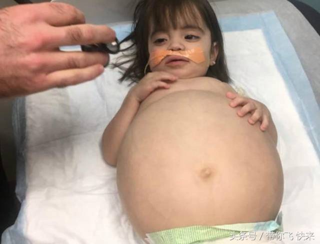 2岁小女孩生怪病 肚子大如气球差点死掉