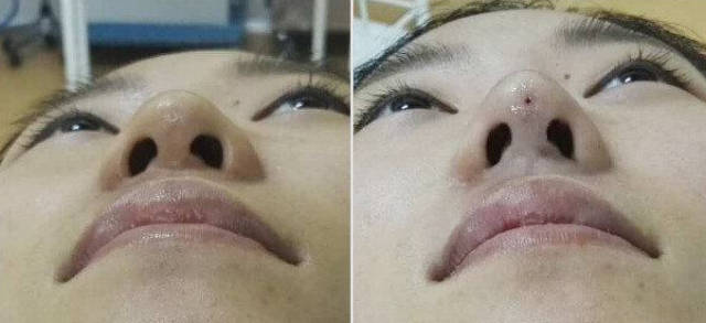 蛋白线隆鼻,线雕鼻子的危害,5分钟看懂原因