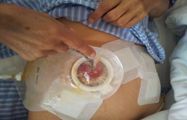 膀胱造瘘换管子图片图片