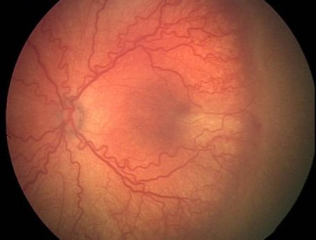 早产儿视网膜病变