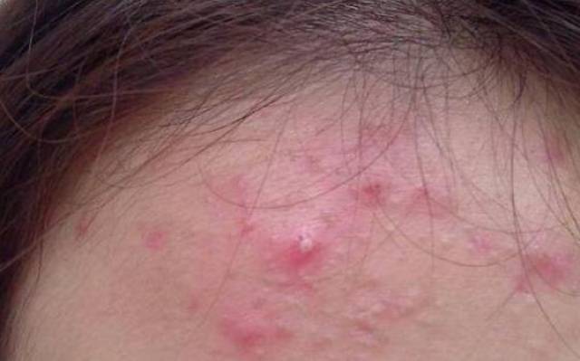 憋下去的红色痘印,有一天居然又长出了红肿痘痘