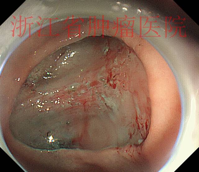 胃窦溃疡型早癌,您会怎么处理?