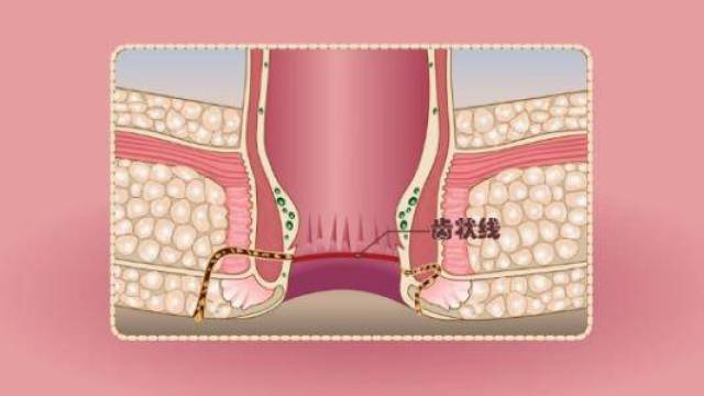 肛瘘该怎么治疗?最佳方法