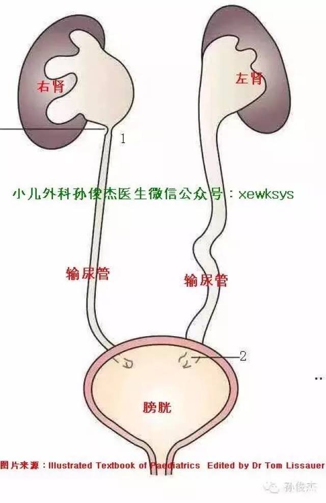谈谈胎儿和小儿肾积水,不紧张,也别大意